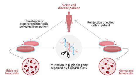 First CRISPR Gene Editing Treatment for Sickle Cell Disease - EDITSCD