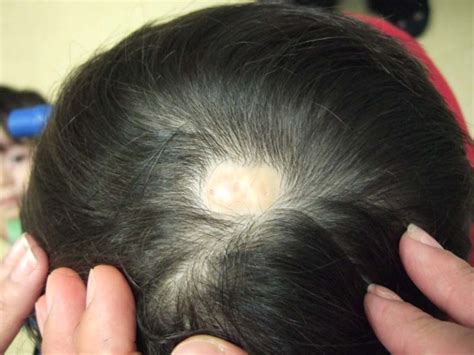 Aplasia Cutis Congenita (congenital skin anomaly) - Dermatology Advisor