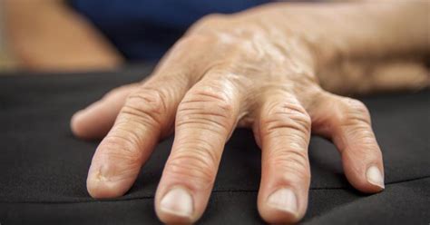 Symptoms of Rheumatoid Arthritis in the Hands and Fingers | LIVESTRONG.COM