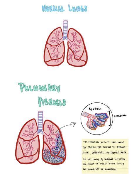 Pulmonary Fibrosis