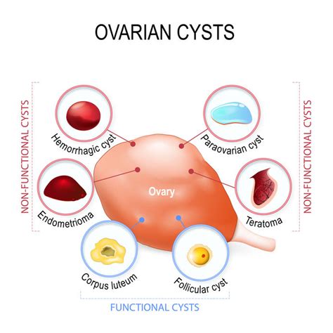 Ovarian Cysts – The Golden Lady