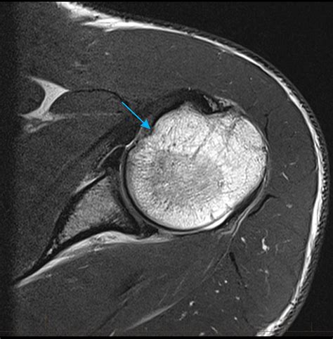 MRI Shoulder - Musculoskeletal Imaging