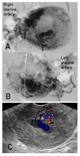 Clinical Complications Induced by Placental Site Subinvolution: Secondary-Type Hemorrhage after ...