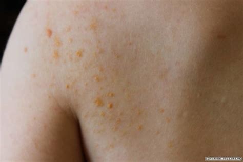 Xanthoma - Types, Symptoms, Causes And Risk Factors