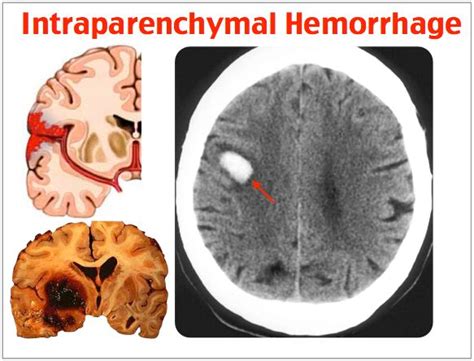 Rosh Review | Medical mnemonics, Radiology imaging, Neurology