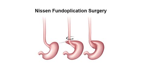 Precautions after a Nissen (laparoscopic) Fundoplication Surgery for GERD