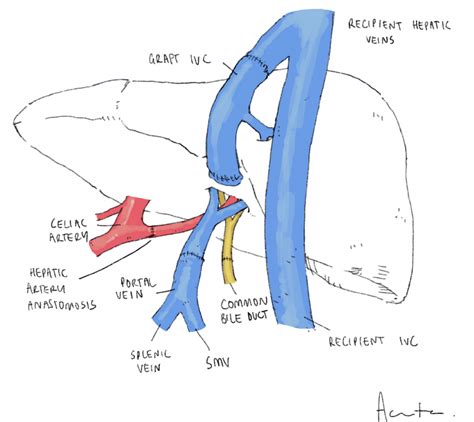 Liver Transplantation - TeachMeSurgery