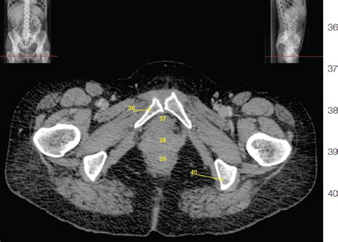 Pelvic Muscle Anatomy Ct - Human Anatomy