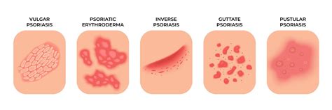 Allergic Eczema Types, Rashes Dermatology Infect By Microvector ...