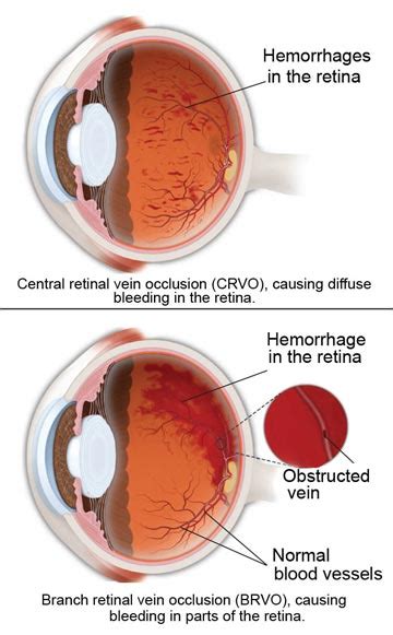 Retinal Vein Occlusion - South Bay Ophthalmology