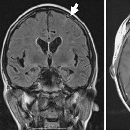 Enhancement along the leptomeninges (arrows) on Gdenhanced magnetic... | Download Scientific Diagram