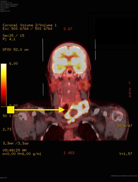 Anaplastic Thyroid Cancer Diagnosis