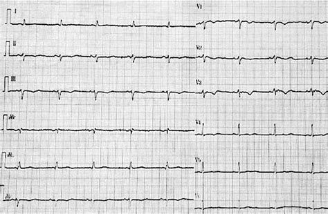 An epsilon wave on electrocardiogram | The BMJ