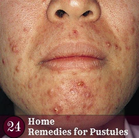 Home Remedies for Pustules | Health Villas (With images) | Skin care pimples, Anti aging skin ...