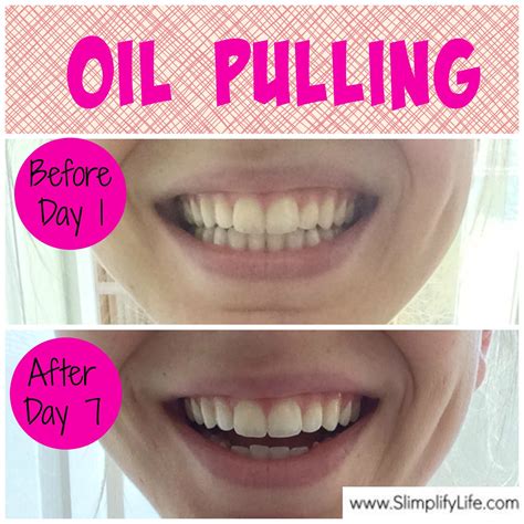 Oil Pulling Benefits and Before and After Pictures. Coconut Oil works great! | oil pulling | Oil ...