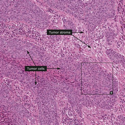 Lung Carcinoma Histology