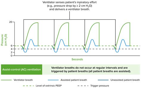 Invasive Mechanical Ventilation | Concise Medical Knowledge