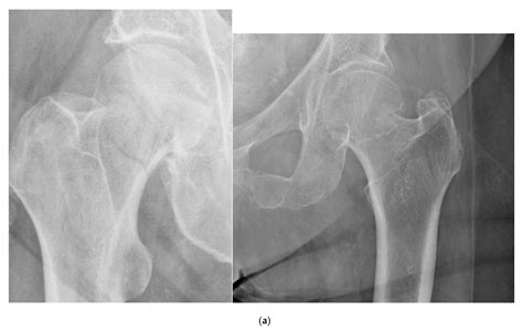 Left Femoral Neck Osteoporosis