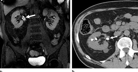 Urinary tract calculi in a 62-year-old man with hematuria. (a) Coronal... | Download Scientific ...