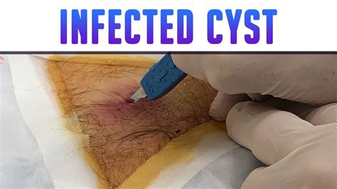 Infected Back Cyst - Drained and Packed - YouTube