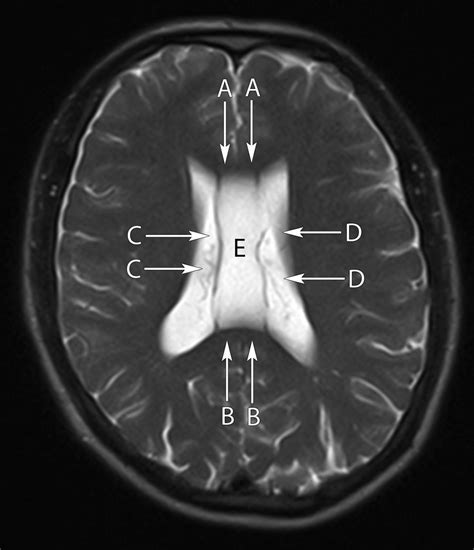 Axial T2 weighted magnetic resonance image at the level of the lateral ventricles | The BMJ