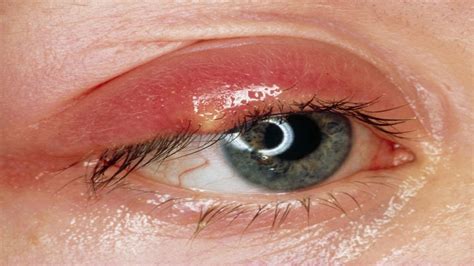 How to Treat Eye Infection at Home. - YouTube