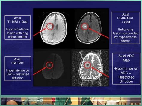 Ring Enhancing Lesions