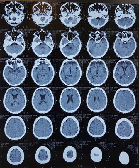 Figure No. 3 -Brain CT scan The results of the chest CT scan (Fig. No.... | Download Scientific ...