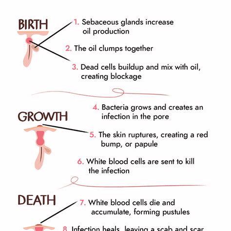 Pimples: How Do They Form & How Long Do They Last?