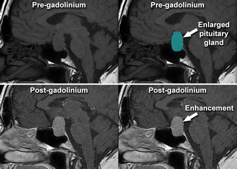 MRI Gallery - MRI Pituitary - Pituitary adenoma