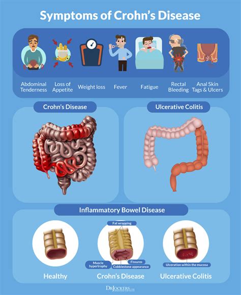 Crohn’s Disease: Symptoms, Causes and Support Strategies