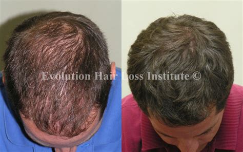 Before and After Hair Growth Treatment Photos