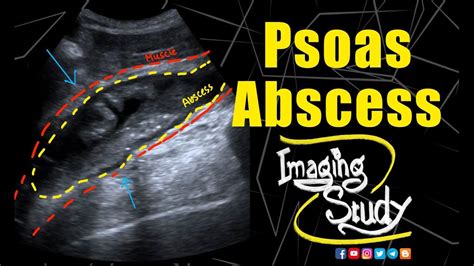 Psoas Sign Radiology