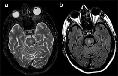 4 Central Pontine Myelinolysis (CPM). A 61-year-old male with history... | Download Scientific ...