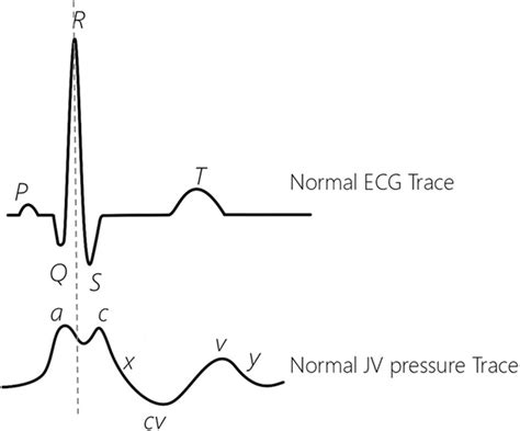 A normal ECG trace (on the top) and Jugular venous (JV) pressure... | Download Scientific Diagram