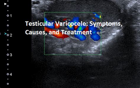 Testicular Varicocele: Symptoms, Causes, And Treatment - Contour Cafe