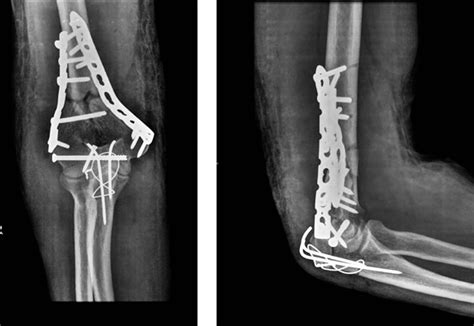 Open Reduction and Internal Fixation | Ganesh Ortho Trauma & Medical Centre