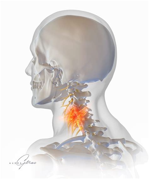 Cervical Nerve Root Impingement - Geras Healthcare Productions