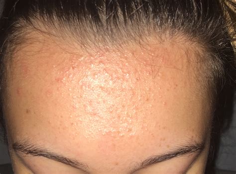 Forehead bumps? Acne? Nothing works! - General acne discussion - Acne.org