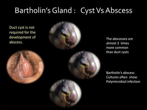 Bartholin gland cyst | PPT