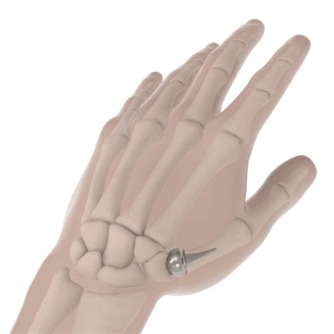 Modular Thumb Implant | Arthritis of the Thumb