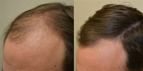 Finasteride Before and After Photos [2024]