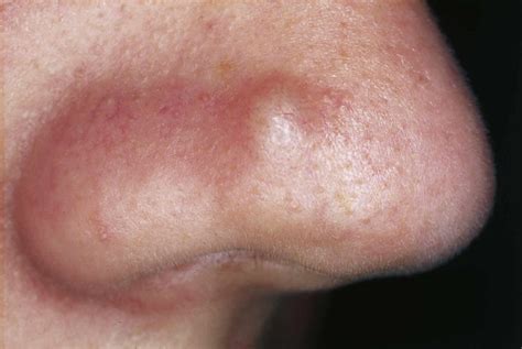 Papule or fibrous papules on nose causes, diagnosis & papule treatment