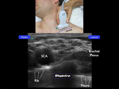 Supraclavicular Brachial Plexus — Highland EM Ultrasound Fueled pain ...