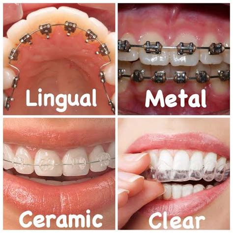 Types of Orthodontic Appliances - Alan J. Schwartz, DDS, PC