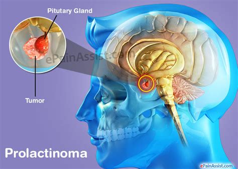 What is a prolactinoma and how can it affect a person’s sexual function? - Men's Health Clinic ...