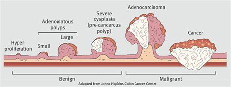 Stages Of Colorectal Cancer