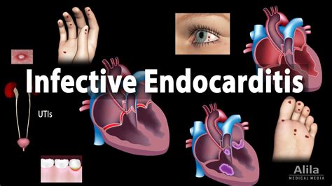 Can You Have Endocarditis Without A Fever? All Answers - Musicbykatie.com