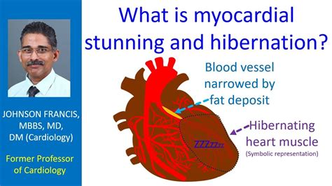 What is myocardial stunning and hibernation? - YouTube