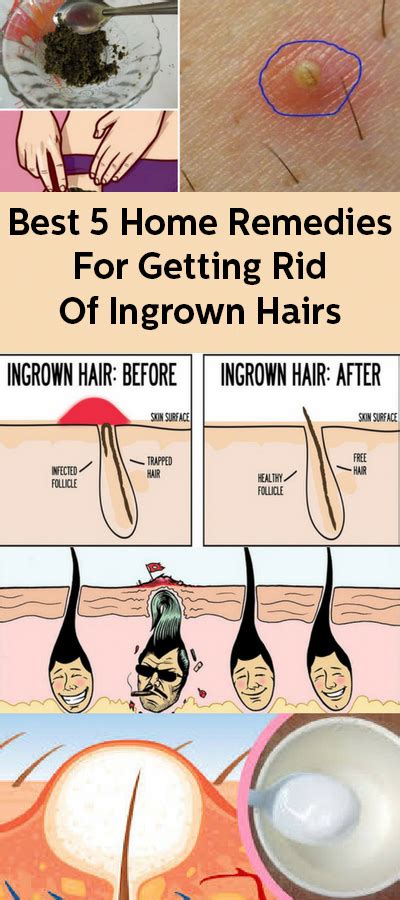 Best 5 Home Remedies For Getting Rid Of Ingrown Hairs #PermanentFacialHairRemoval in 2020 ...